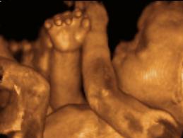 Quando fazer o ultrassom 3D ou 4D na gravidez