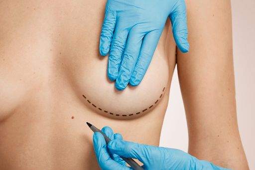 Mamoplastia: o que é e como é feito esse procedimento que transforma autoestima e bem-estar